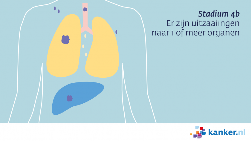Bij longkanker stadium 4b zijn er uitzaaiingen naar 1 of meer organen.