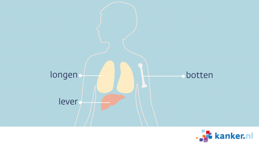 Oogmelanoom kan uitzaaien naar de botten, de longen of de lever.