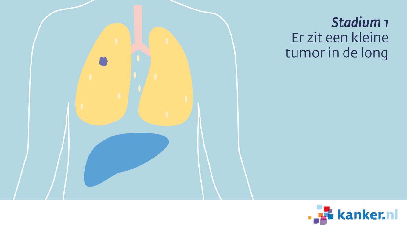 Bij longkanker in stadium 1 zit er een kleine tumor in de long.