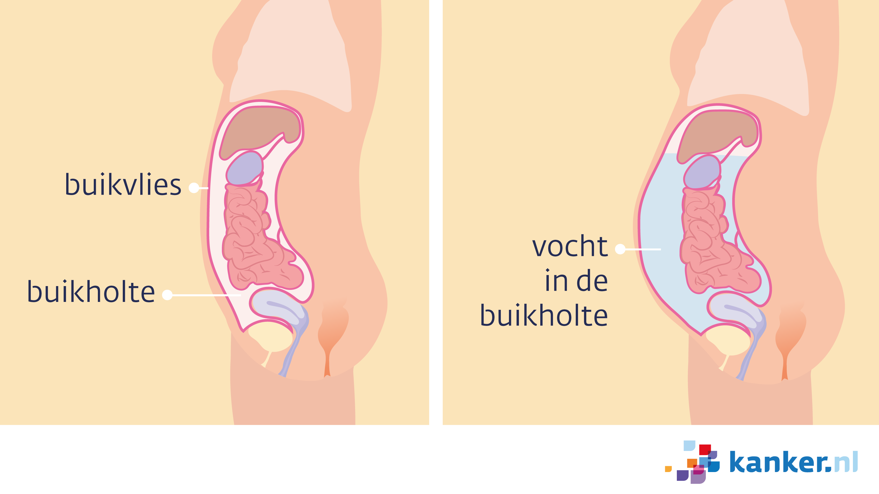 vocht in de buikholte (ascites)