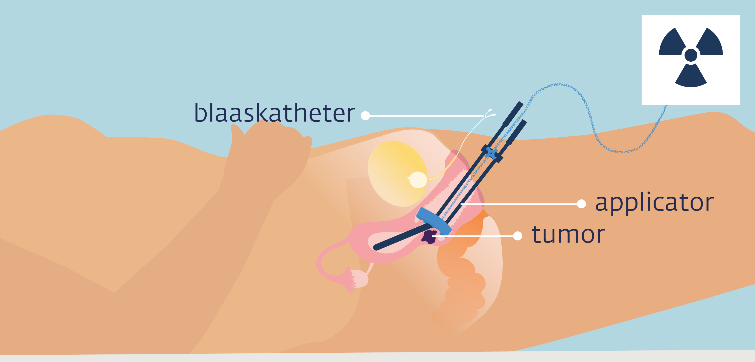 inwendige bestraling tumor baarmoederhals