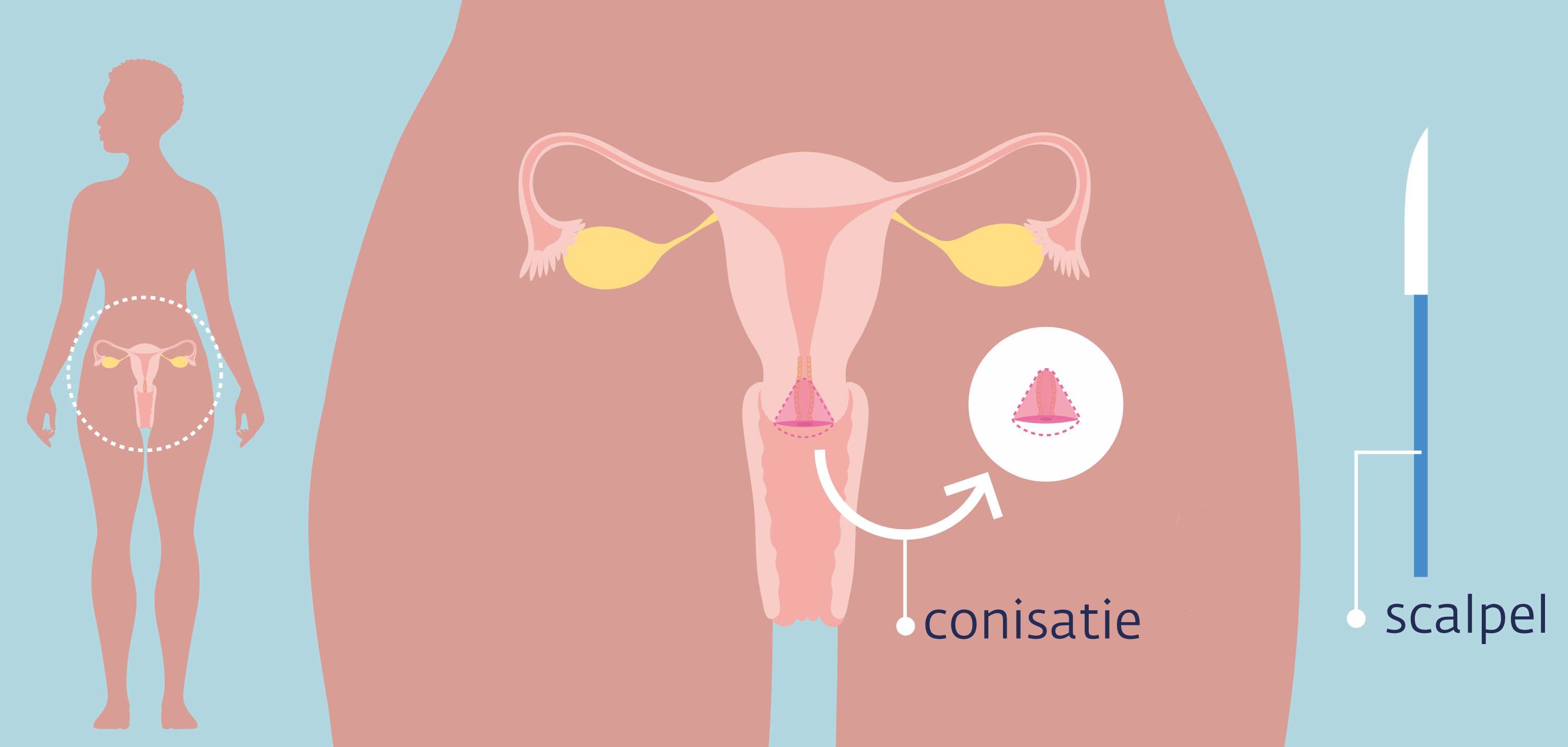 conisatie