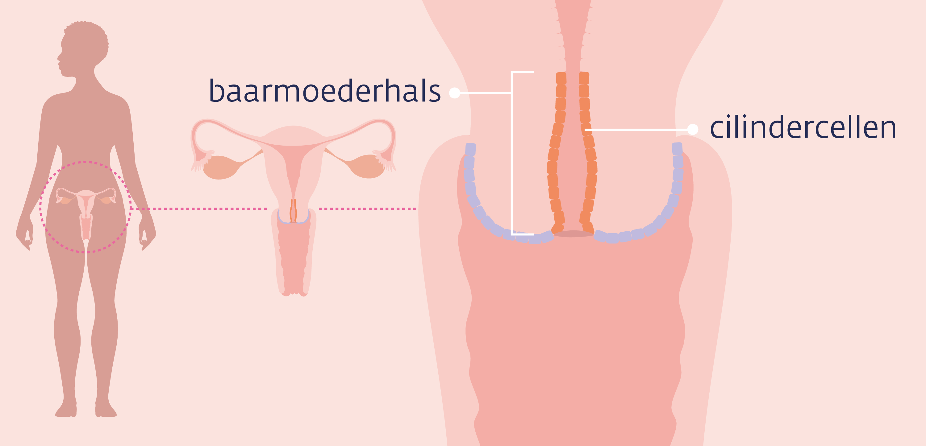 adenocarcinoma in situ