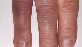 Kanker gevonden in mijn pink rechterhand, gisteren Vrijdag 14 april 2023 pink verwijderd aan mijn rechterhand in het Antoni van Leeuwenhoekziekenhuis in Amsterdam