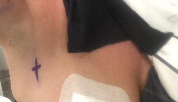 Aanduiding sentinelklier en plaatsen harpoen 