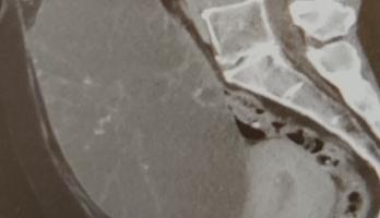 grote multicysteuze cyste (groot ovaal grijze geval)