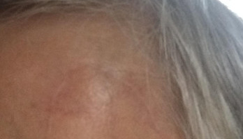 Het litteken. Dat is wel heel mooi genezen.👌