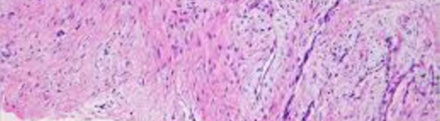 Ik en mijn Desmoid Sarcoom Tumor in mijn schouder