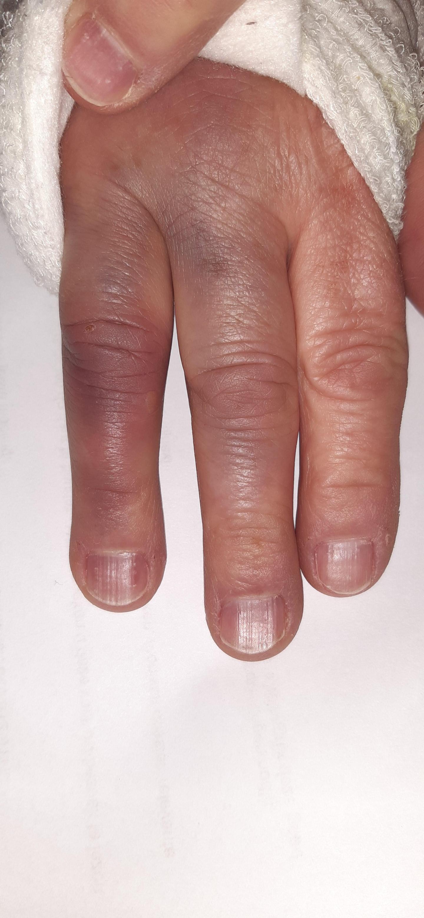 Kanker gevonden in mijn pink rechterhand, gisteren Vrijdag 14 april 2023 pink verwijderd aan mijn rechterhand in het Antoni van Leeuwenhoekziekenhuis in Amsterdam