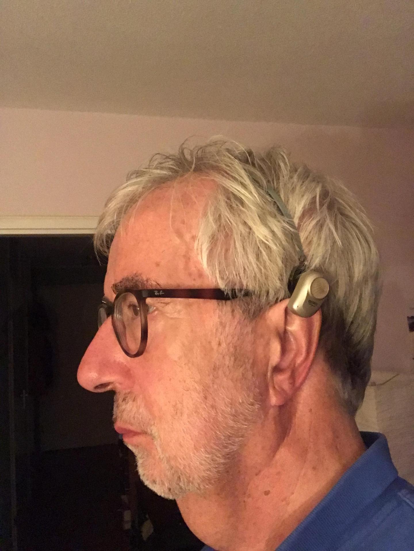 Ervaringen met gehoorapparaat na operatie 