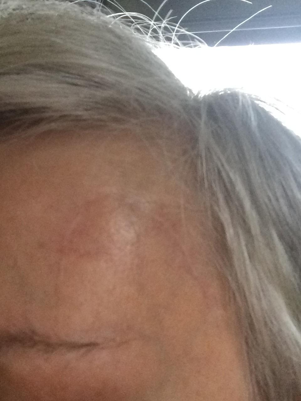 Het litteken. Dat is wel heel mooi genezen.👌