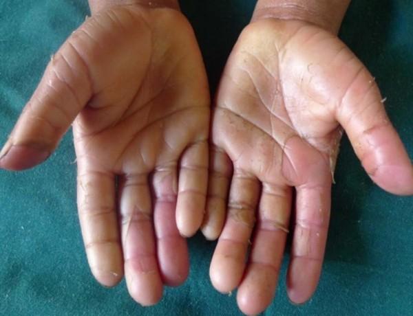 Hand- en voetsyndroom: wat is het wat kun er aan doen? | Kanker.nl