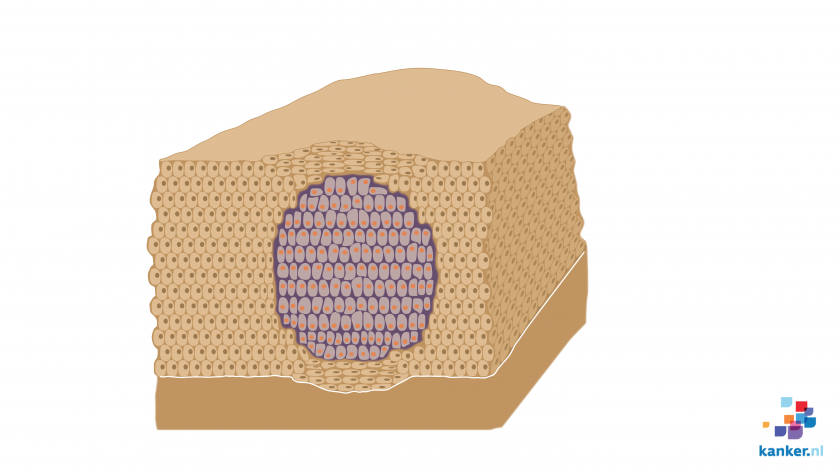 Goedaardige tumor