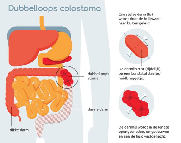 Dubbelloops colostoma