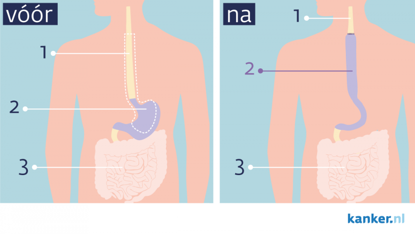 Operatie bij maagkanker (maagcarcinoom)