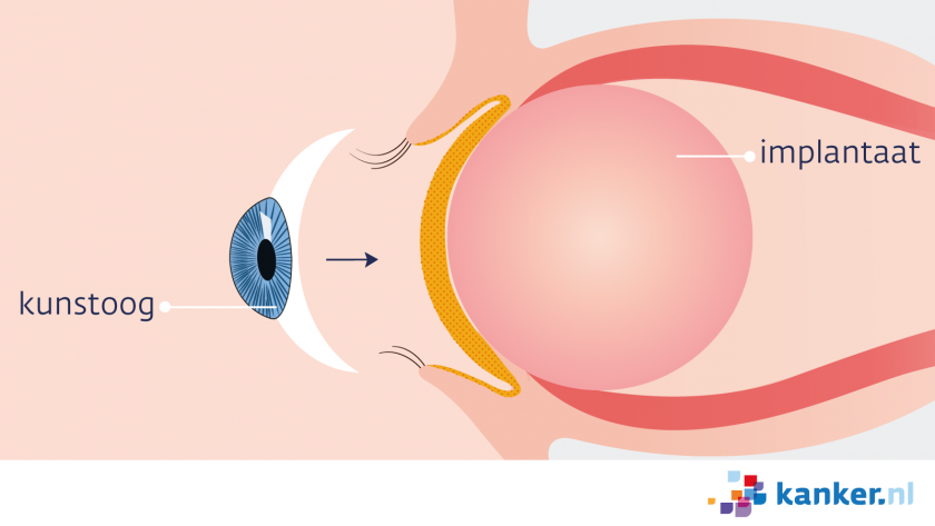 Na verwijderen van het oog wordt een implantaat in de oogkas geplaatst. Later wordt daar een kunstoog op gezet.