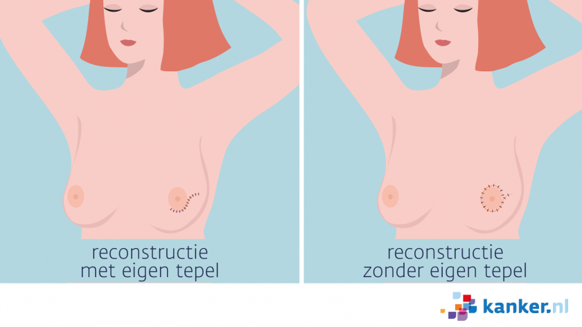 Reconstructie na borstamputatie met en zonder eigen tepel.