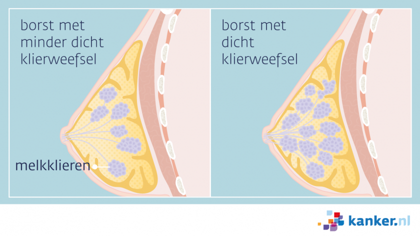 Bij dicht borstklierweefsel zitten er meer melkklieren in de borst dan gemiddeld.