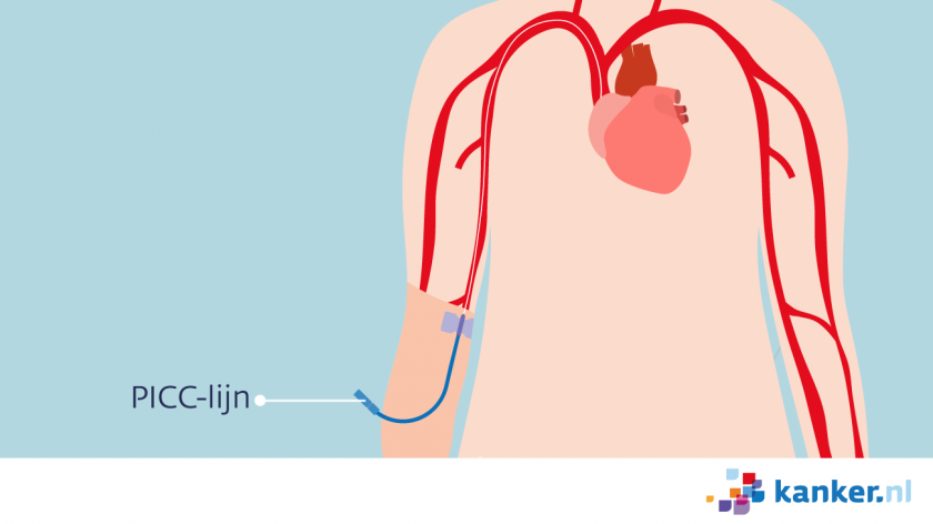 PICC-lijn bij chemotherapie