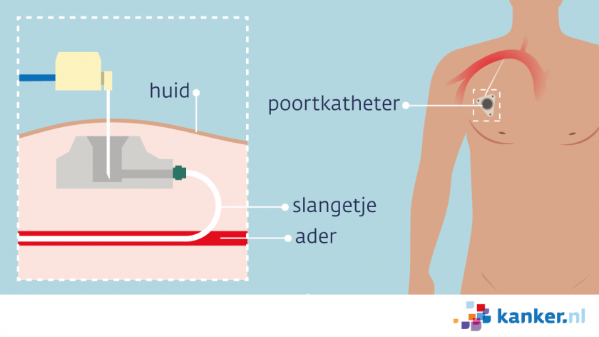 Een poortkatheter (port-a-cath) zit onder de huid in het bovenste deel van de borstkas of de arm. De medicijnen komen via het slangetje in een bloedvat.