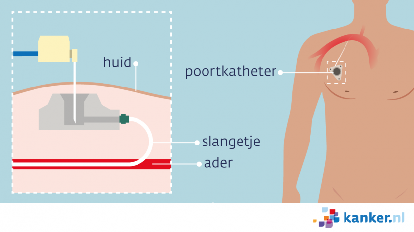 Een poortkatheter zit onder de huid in het bovenste deel van de borstkas of de arm. De medicijnen komen via het slangetje in een bloedvat.