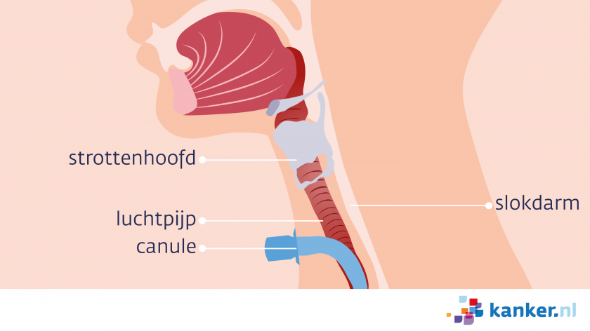 Bij een operatie voor keelkanker krijg je een tracheotomie. Via de hals krijg je een buisje in de luchtpijp om adem te halen.