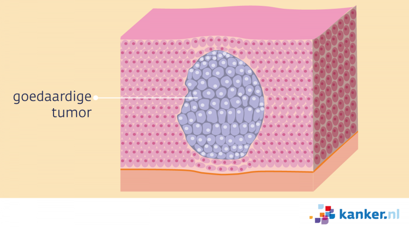 Een goedaardige tumor bevat geen kankercellen en groeit niet in het omliggend weefsel.