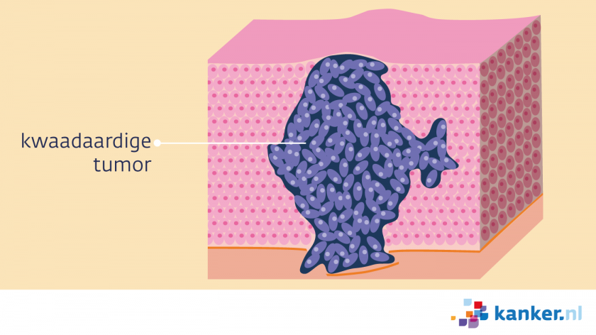 Bij een kwaadaardige tumor dringen de kankercellen het omliggend weefsel binnen.