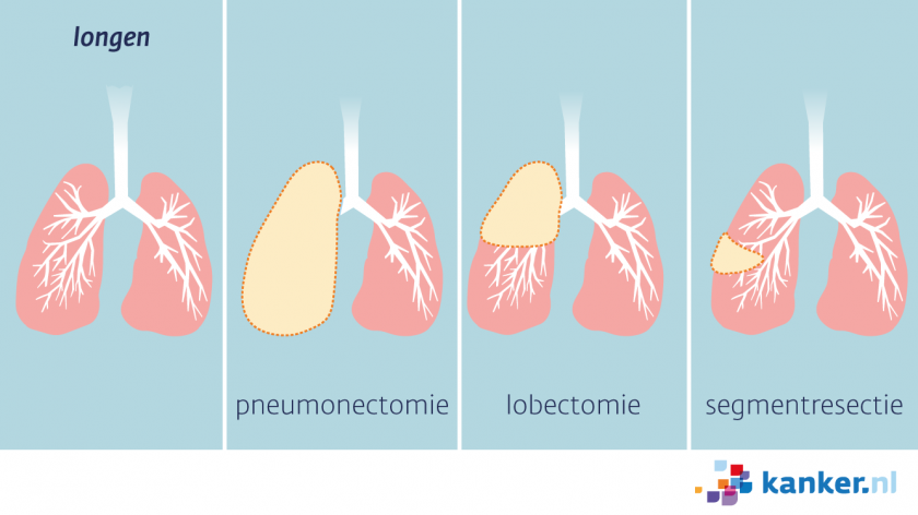 Een operatie bij longkanker kan een pneumectomie, een lobectomie of een segmentresectie zijn.