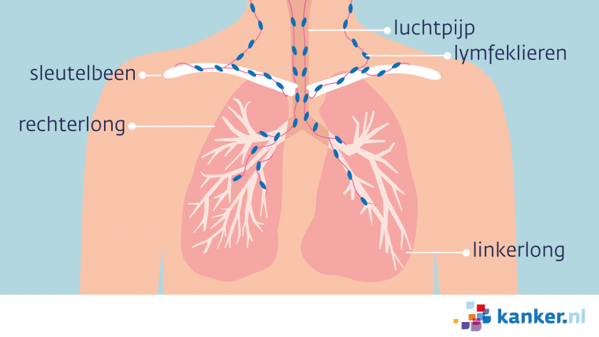 Regionale uitzaaiingen van longkanker zitten in de lymfeklieren tussen de longen, in de hals of bij het sleutelbeen.