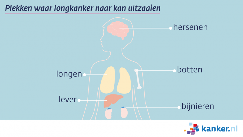 Longkanker kan uitzaaien naar de hersenen, de botten, de longen, de lever en de bijnieren.