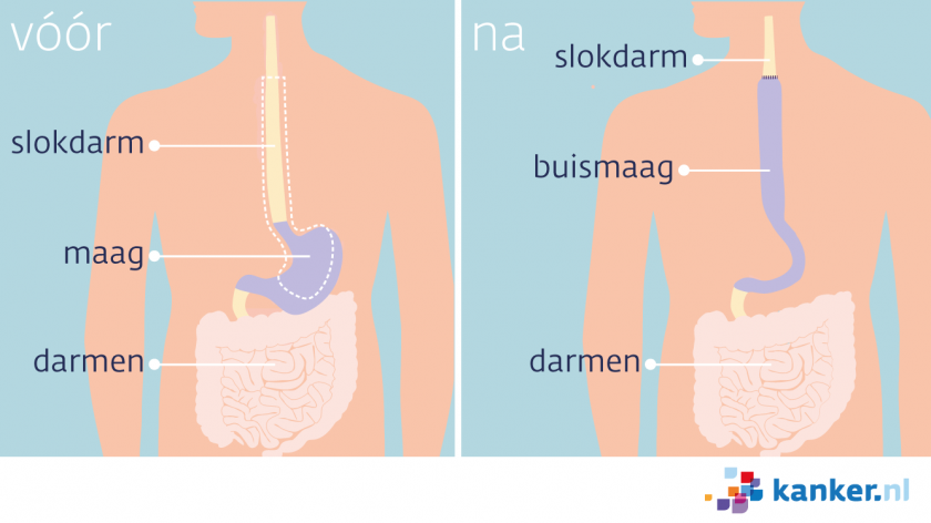 Bij maagkanker krijg je soms een buismaagoperatie. De arts verwijdert dan het onderste deel van de slokdarm en het bovenste deel van de maag.