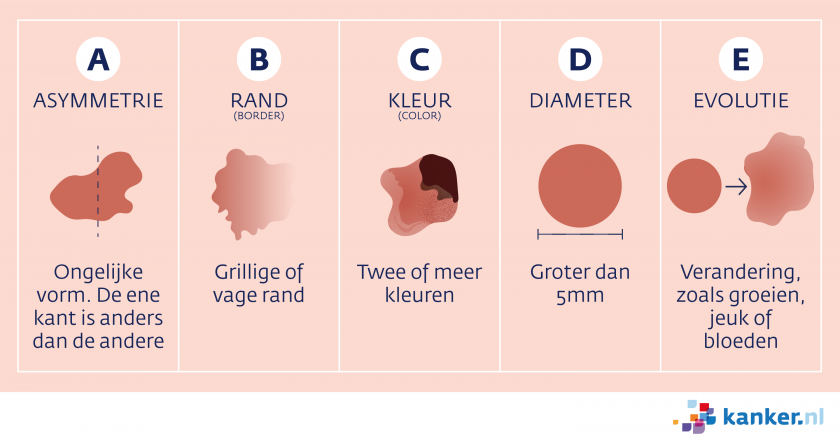 Melanoom herkennen met de ABCDE-regel: asymmetrie, rand, kleur, diameter en evolutie.