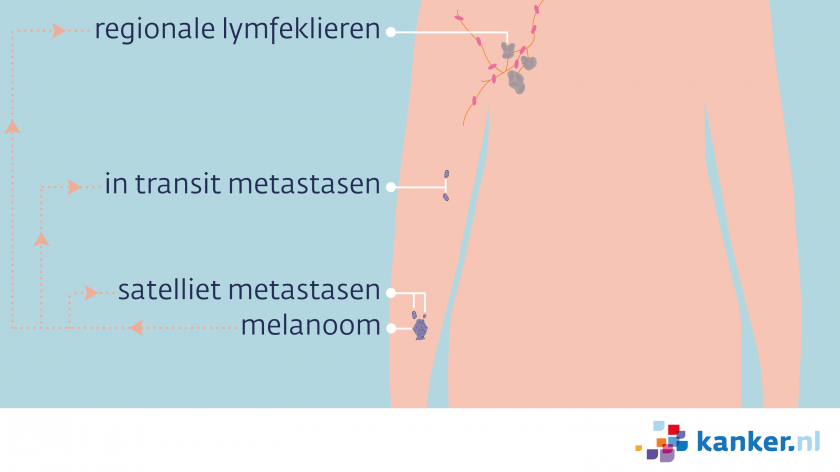 Uitzaaiingen van een melanoom op de arm kunnen satelliet of in transit uitzaaiingen zijn, of in lokale lymfeklieren zitten.