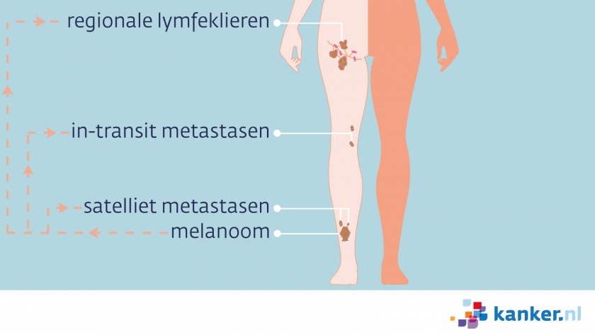 Uitzaaiingen van een melanoom op het been kunnen satelliet of in transit uitzaaiingen zijn, of in lokale lymfeklieren zitten.