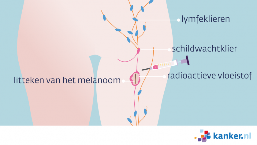 Stap 1 in de schildwachtklierprocedure melanoom is de schildwachtklier opsporen.