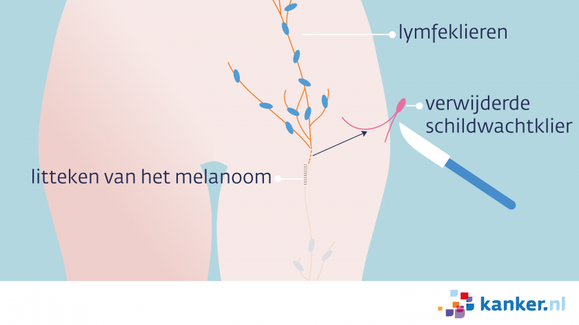 Stap 2 in de schildwachtklierprocedure melanoom is de schildwachtklier verwijderen.