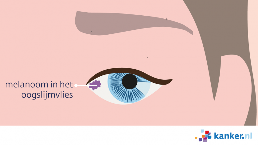 Een melanoom in het oogslijmvlies ziet eruit als een donker plekje in het oogwit.