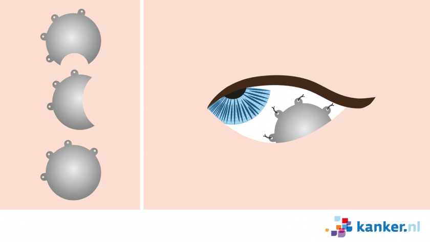 Bij rutheniumbestraling bij oogmelanoom plaatst de oogarts een schildje op de buitenkant van de oogbol, op de plek waar binnenin het oog het melanoom zit. 