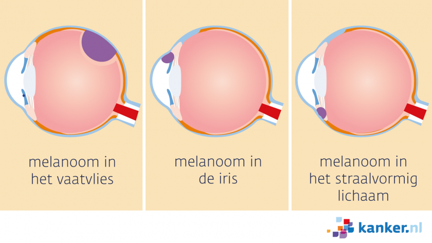 Een uveamelanoom begint in het vaatvlies, in de iris of in het straalvormig lichaam.