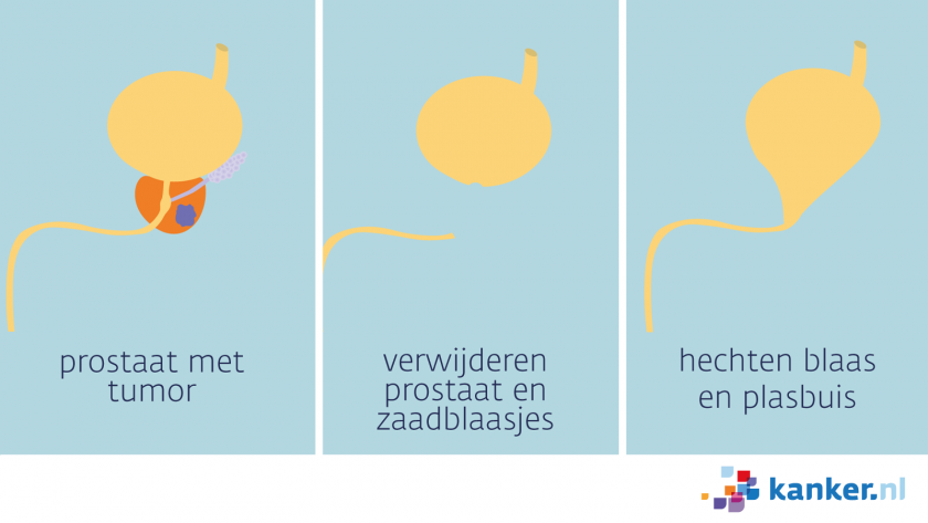 prostaatverwijdering