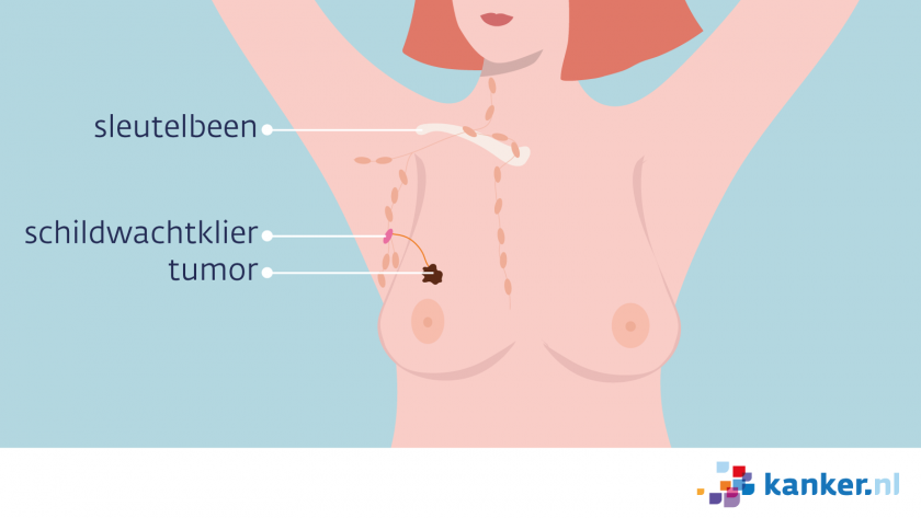 De schildwachtklier kan op meerdere plekken rond de borst zitten.