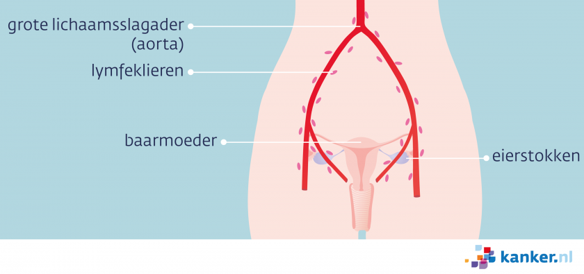 Meestal zaait eierstokkanker uit naar de lymfeklieren in het kleine bekken en rond de grote lichaamsslagader (aorta).
