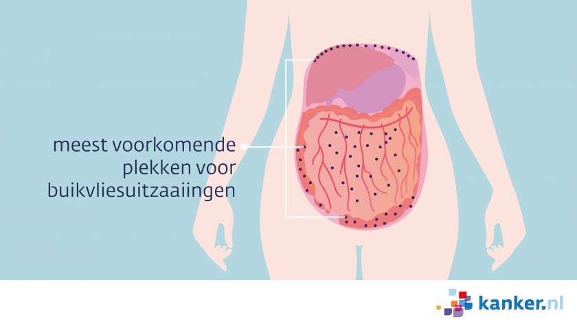 Uitzaaiingen op het buikvlies