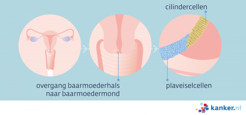 De overgang van de baarmoederhals naar de baarmoedermond. Aan de binnenkant het slijmvlies zitten cilindercellen, aan de buitenkant plaveiselcellen.