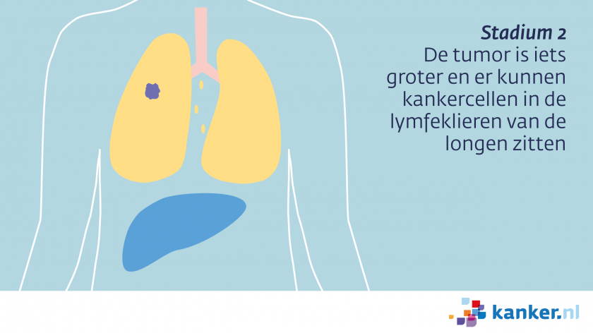 Bij longkanker stadium 2 kunnen kankercellen in de lymfeklieren van de longen zitten.