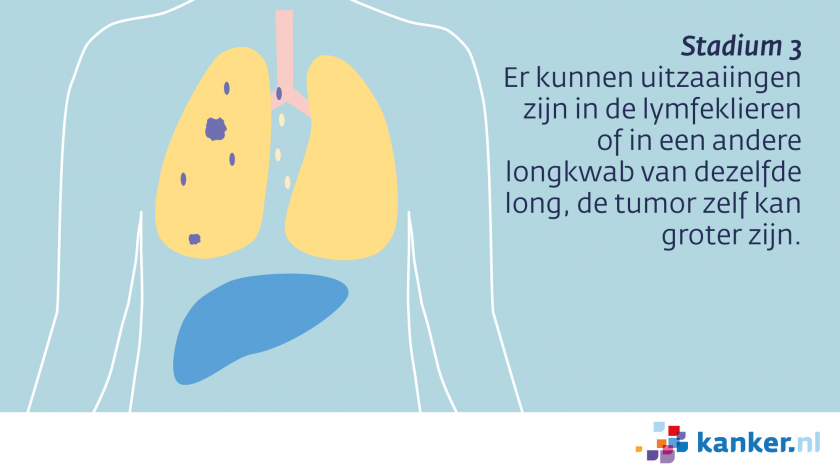 Bij longkanker stadium 3 zijn er uitzaaiingen in de lymfeklieren of een andere longkwab.