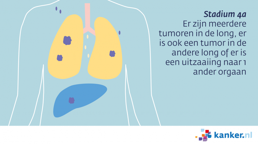 Bij longkanker stadium 4a zijn er meerdere tumoren in de longen of een uitzaaiing naar 1 ander orgaan.