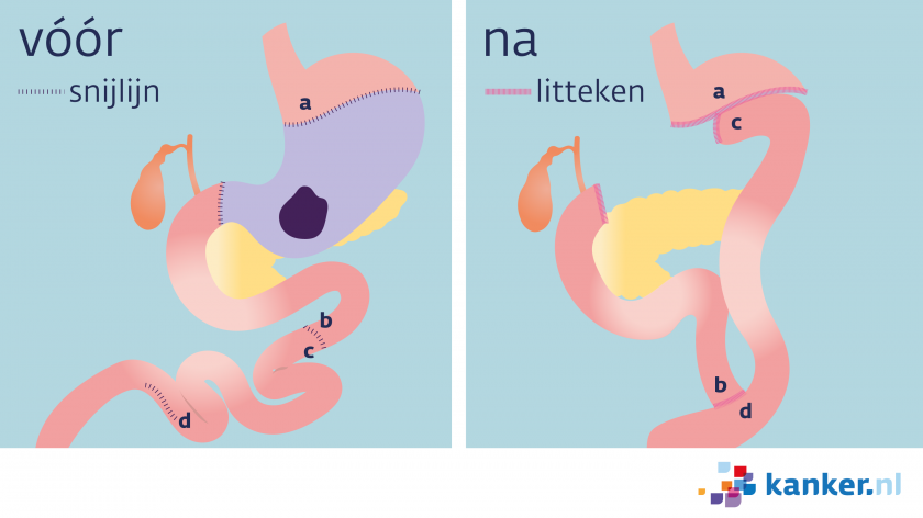 Bij maagkanker krijg je soms een partiële maagresectie. De arts verwijdert dan het onderste deel van de mag en een stuk van de dunne darm.