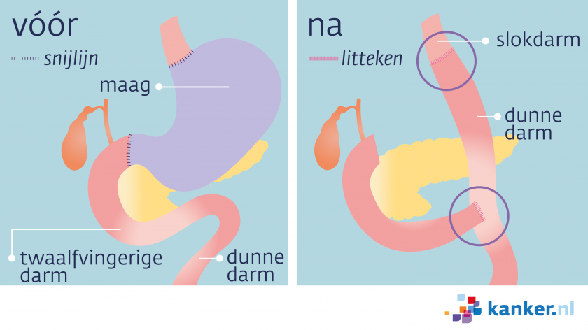 Bij maagkanker krijg je soms een totale maagresectie. De arts verwijdert dan de maag en de twaalfvingerige darm.